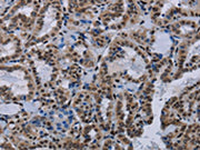 The image on the left is immunohistochemistry of paraffin-embedded Human thyroid cancer tissue using CSB-PA225274(HMGB1 Antibody) at dilution 1/30, on the right is treated with synthetic peptide. (Original magnification: ×200)
