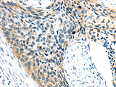 The image on the left is immunohistochemistry of paraffin-embedded Human esophagus cancer tissue using CSB-PA225304(AEBP1 Antibody) at dilution 1/25, on the right is treated with synthetic peptide. (Original magnification: ×200)