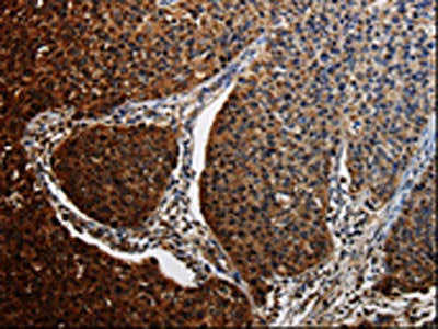 The image on the left is immunohistochemistry of paraffin-embedded Human renal cancer tissue using CSB-PA225375(BID Antibody) at dilution 1/25, on the right is treated with fusion protein. (Original magnification: ×200)