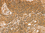 The image on the left is immunohistochemistry of paraffin-embedded Human esophagus cancer tissue using CSB-PA225382(STX10 Antibody) at dilution 1/35, on the right is treated with fusion protein. (Original magnification: ×200)