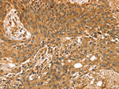 The image on the left is immunohistochemistry of paraffin-embedded Human esophagus cancer tissue using CSB-PA225382(STX10 Antibody) at dilution 1/35, on the right is treated with fusion protein. (Original magnification: ×200)