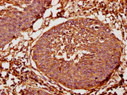 IHC image of CSB-PA22539A0Rb diluted at 1:400 and staining in paraffin-embedded human cervical cancer performed on a Leica BondTM system. After dewaxing and hydration, antigen retrieval was mediated by high pressure in a citrate buffer (pH 6.0). S...
