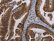 The image on the left is immunohistochemistry of paraffin-embedded Human gastric cancer tissue using CSB-PA225412(MAGEB3 Antibody) at dilution 1/20, on the right is treated with synthetic peptide. (Original magnification: ×200)