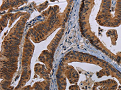 The image on the left is immunohistochemistry of paraffin-embedded Human gastric cancer tissue using CSB-PA225412(MAGEB3 Antibody) at dilution 1/20, on the right is treated with synthetic peptide. (Original magnification: ×200)