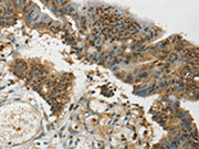 The image on the left is immunohistochemistry of paraffin-embedded Human colon cancer tissue using CSB-PA225456(SYCP1 Antibody) at dilution 1/35, on the right is treated with synthetic peptide. (Original magnification: ×200)