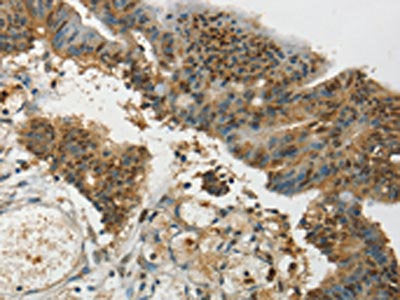 The image on the left is immunohistochemistry of paraffin-embedded Human colon cancer tissue using CSB-PA225456(SYCP1 Antibody) at dilution 1/35, on the right is treated with synthetic peptide. (Original magnification: ×200)