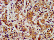 IHC image of CSB-PA22559A0Rb diluted at 1:200 and staining in paraffin-embedded human liver cancer performed on a Leica BondTM system. After dewaxing and hydration, antigen retrieval was mediated by high pressure in a citrate buffer (pH 6.0). Sect...