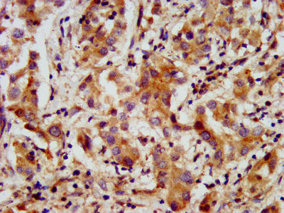 IHC image of CSB-PA22559A0Rb diluted at 1:200 and staining in paraffin-embedded human liver cancer performed on a Leica BondTM system. After dewaxing and hydration, antigen retrieval was mediated by high pressure in a citrate buffer (pH 6.0). Sect...