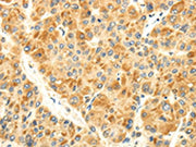 The image on the left is immunohistochemistry of paraffin-embedded Human liver cancer tissue using CSB-PA225608(S1PR2 Antibody) at dilution 1/30, on the right is treated with synthetic peptide. (Original magnification: ×200)