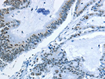The image on the left is immunohistochemistry of paraffin-embedded Human colon cancer tissue using CSB-PA225643(NEK4 Antibody) at dilution 1/25, on the right is treated with synthetic peptide. (Original magnification: ×200)