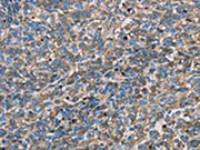 The image on the left is immunohistochemistry of paraffin-embedded Human ovarian cancer tissue using CSB-PA225650(APOA1 Antibody) at dilution 1/25, on the right is treated with fusion protein. (Original magnification: ×200)