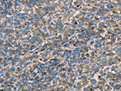 The image on the left is immunohistochemistry of paraffin-embedded Human ovarian cancer tissue using CSB-PA225650(APOA1 Antibody) at dilution 1/25, on the right is treated with fusion protein. (Original magnification: ×200)
