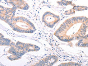 The image on the left is immunohistochemistry of paraffin-embedded Human colon cancer tissue using CSB-PA225678(F9 Antibody) at dilution 1/45, on the right is treated with fusion protein. (Original magnification: ×200)