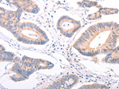 The image on the left is immunohistochemistry of paraffin-embedded Human colon cancer tissue using CSB-PA225678(F9 Antibody) at dilution 1/45, on the right is treated with fusion protein. (Original magnification: ×200)