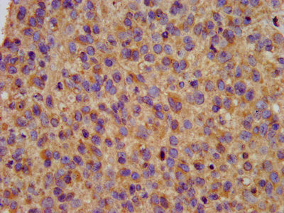 IHC image of CSB-PA22569A0Rb diluted at 1:200 and staining in paraffin-embedded human glioma performed on a Leica BondTM system. After dewaxing and hydration, antigen retrieval was mediated by high pressure in a citrate buffer (pH 6.0). Section wa...