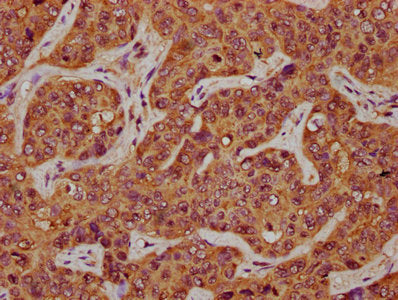 IHC image of CSB-PA22579A0Rb diluted at 1:200 and staining in paraffin-embedded human liver cancer performed on a Leica BondTM system. After dewaxing and hydration, antigen retrieval was mediated by high pressure in a citrate buffer (pH 6.0). Sect...