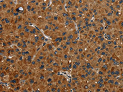 The image on the left is immunohistochemistry of paraffin-embedded Human liver cancer tissue using CSB-PA225804(NR3C1 Antibody) at dilution 1/30, on the right is treated with fusion protein. (Original magnification: ×200)