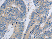 The image on the left is immunohistochemistry of paraffin-embedded Human colon cancer tissue using CSB-PA225945(PAWR Antibody) at dilution 1/60, on the right is treated with synthetic peptide. (Original magnification: ×200)