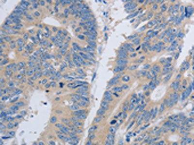 The image on the left is immunohistochemistry of paraffin-embedded Human colon cancer tissue using CSB-PA225945(PAWR Antibody) at dilution 1/60, on the right is treated with synthetic peptide. (Original magnification: ×200)