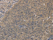 The image on the left is immunohistochemistry of paraffin-embedded Human cervical cancer tissue using CSB-PA225962(HSF1 Antibody) at dilution 1/60, on the right is treated with fusion protein. (Original magnification: ×200)