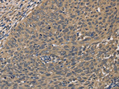 The image on the left is immunohistochemistry of paraffin-embedded Human cervical cancer tissue using CSB-PA225962(HSF1 Antibody) at dilution 1/60, on the right is treated with fusion protein. (Original magnification: ×200)
