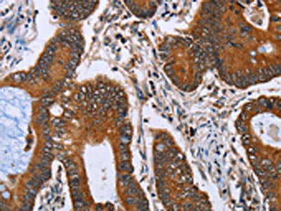 The image on the left is immunohistochemistry of paraffin-embedded Human colon cancer tissue using CSB-PA226317(IHH Antibody) at dilution 1/30, on the right is treated with fusion protein. (Original magnification: ×200)