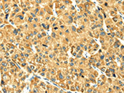 The image on the left is immunohistochemistry of paraffin-embedded Human liver cancer tissue using CSB-PA226407(RAB2A Antibody) at dilution 1/25, on the right is treated with fusion protein. (Original magnification: ×200)