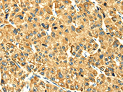The image on the left is immunohistochemistry of paraffin-embedded Human liver cancer tissue using CSB-PA226407(RAB2A Antibody) at dilution 1/25, on the right is treated with fusion protein. (Original magnification: ×200)