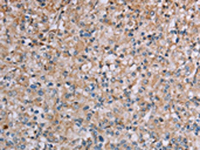 The image on the left is immunohistochemistry of paraffin-embedded Human prostate cancer tissue using CSB-PA226742(PLXNA4 Antibody) at dilution 1/50, on the right is treated with synthetic peptide. (Original magnification: ×200)