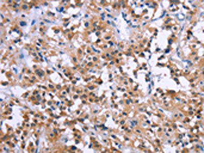 The image on the left is immunohistochemistry of paraffin-embedded Human thyroid cancer tissue using CSB-PA226932(GNPAT Antibody) at dilution 1/30, on the right is treated with synthetic peptide. (Original magnification: ×200)