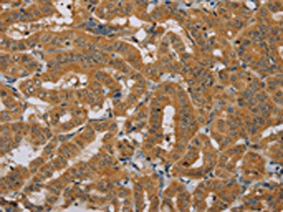 The image is immunohistochemistry of paraffin-embedded Human thyroid cancer tissue using CSB-PA226934(NDUFAF1 Antibody) at dilution 1/25. (Original magnification: ×200)