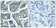 Immunohistochemical analysis of paraffin-embedded human breast carcinoma tissue using PLC-g2(Phospho-Tyr1217) Antibody(left) or the same antibody preincubated with blocking peptide(right).