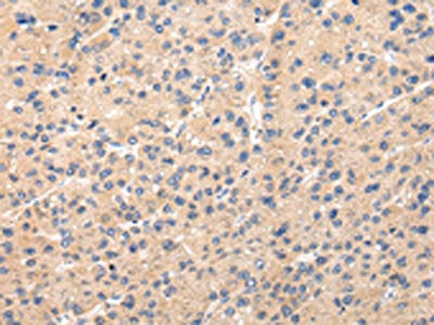 The image on the left is immunohistochemistry of paraffin-embedded Human liver cancer tissue using CSB-PA227161(PPP5C Antibody) at dilution 1/20, on the right is treated with fusion protein. (Original magnification: ×200)