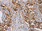 The image on the left is immunohistochemistry of paraffin-embedded Human breast cancer tissue using CSB-PA227378(NDUFS1 Antibody) at dilution 1/50, on the right is treated with fusion protein. (Original magnification: ×200)