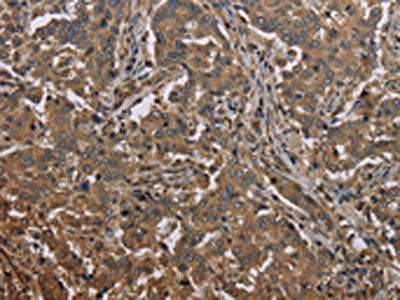 The image on the left is immunohistochemistry of paraffin-embedded Human liver cancer tissue using CSB-PA227420(MCC Antibody) at dilution 1/30, on the right is treated with synthetic peptide. (Original magnification: ×200)