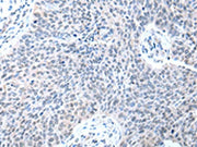 The image on the left is immunohistochemistry of paraffin-embedded Human lung cancer tissue using CSB-PA227440(STRAP Antibody) at dilution 1/20, on the right is treated with fusion protein. (Original magnification: ×200)