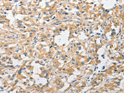 The image on the left is immunohistochemistry of paraffin-embedded Human thyroid cancer tissue using CSB-PA227449(APPBP2 Antibody) at dilution 1/30, on the right is treated with fusion protein. (Original magnification: ×200)