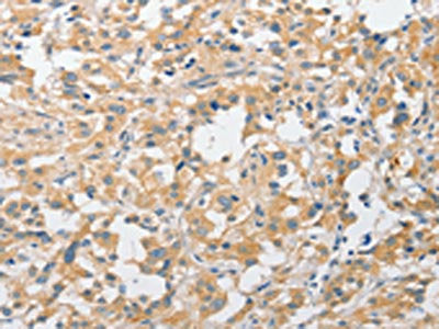 The image on the left is immunohistochemistry of paraffin-embedded Human thyroid cancer tissue using CSB-PA227449(APPBP2 Antibody) at dilution 1/30, on the right is treated with fusion protein. (Original magnification: ×200)