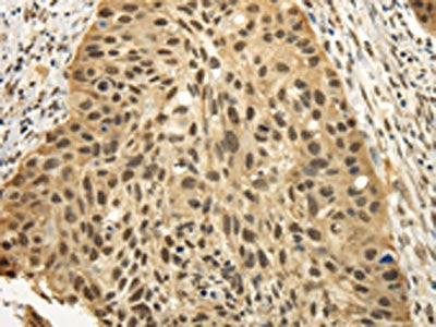 The image on the left is immunohistochemistry of paraffin-embedded Human esophagus cancer tissue using CSB-PA227585(TBL1XR1 Antibody) at dilution 1/25, on the right is treated with fusion protein. (Original magnification: ×200)