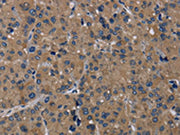 The image on the left is immunohistochemistry of paraffin-embedded Human liver cancer tissue using CSB-PA227659(TRPM1 Antibody) at dilution 1/20, on the right is treated with synthetic peptide. (Original magnification: ×200)