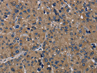 The image on the left is immunohistochemistry of paraffin-embedded Human liver cancer tissue using CSB-PA227659(TRPM1 Antibody) at dilution 1/20, on the right is treated with synthetic peptide. (Original magnification: ×200)
