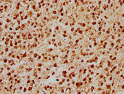 IHC image of CSB-PA22769A0Rb diluted at 1:200 and staining in paraffin-embedded human glioma performed on a Leica BondTM system. After dewaxing and hydration, antigen retrieval was mediated by high pressure in a citrate buffer (pH 6.0). Section wa...