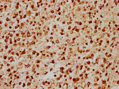 IHC image of CSB-PA22769A0Rb diluted at 1:200 and staining in paraffin-embedded human glioma performed on a Leica BondTM system. After dewaxing and hydration, antigen retrieval was mediated by high pressure in a citrate buffer (pH 6.0). Section wa...