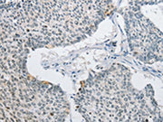 The image on the left is immunohistochemistry of paraffin-embedded Human lung cancer tissue using CSB-PA227771(AP2M1 Antibody) at dilution 1/15, on the right is treated with fusion protein. (Original magnification: ×200)