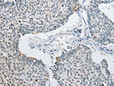 The image on the left is immunohistochemistry of paraffin-embedded Human lung cancer tissue using CSB-PA227771(AP2M1 Antibody) at dilution 1/15, on the right is treated with fusion protein. (Original magnification: ×200)