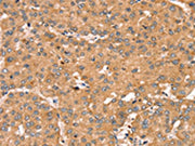 The image on the left is immunohistochemistry of paraffin-embedded Human liver cancer tissue using CSB-PA227800(TRIM14 Antibody) at dilution 1/35, on the right is treated with synthetic peptide. (Original magnification: ×200)