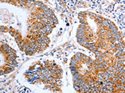 The image on the left is immunohistochemistry of paraffin-embedded Human colon cancer tissue using CSB-PA228012(CLDN10 Antibody) at dilution 1/50, on the right is treated with synthetic peptide. (Original magnification: ×200)