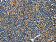 The image on the left is immunohistochemistry of paraffin-embedded Human tonsil tissue using CSB-PA228050(GRB7 Antibody) at dilution 1/40, on the right is treated with fusion protein. (Original magnification: ×200)