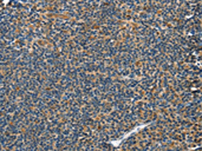 The image on the left is immunohistochemistry of paraffin-embedded Human tonsil tissue using CSB-PA228050(GRB7 Antibody) at dilution 1/40, on the right is treated with fusion protein. (Original magnification: ×200)