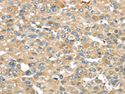 The image on the left is immunohistochemistry of paraffin-embedded Human liver cancer tissue using CSB-PA228089(SRP54 Antibody) at dilution 1/45, on the right is treated with fusion protein. (Original magnification: ×200)